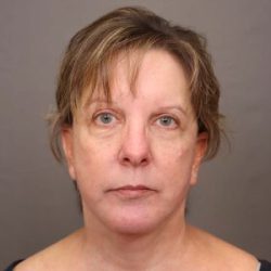 Neck Lift Before & After Patient #4347