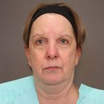 Neck Lift Before & After Patient #4347
