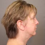 Neck Lift Before & After Patient #4347