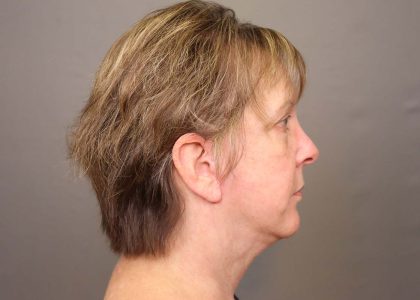 Neck Lift Before & After Patient #4347