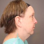 Neck Lift Before & After Patient #4347