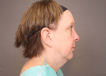 Neck Lift Before & After Patient #4347