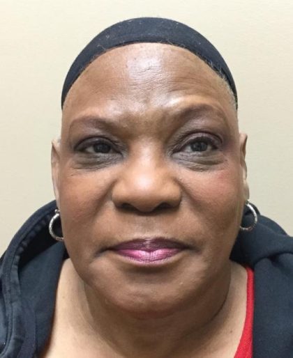 Otoplasty Before & After Patient #3670