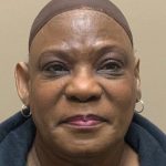 Otoplasty Before & After Patient #3670