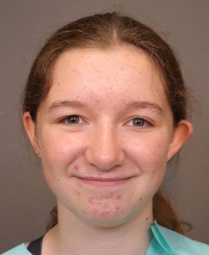 Otoplasty Before & After Patient #3668