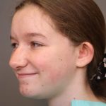 Otoplasty Before & After Patient #3668