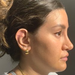 Otoplasty Before & After Patient #3678