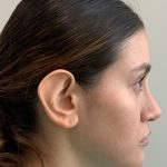 Otoplasty Before & After Patient #3678