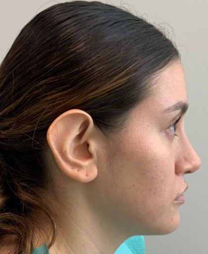 Otoplasty Before & After Patient #3678