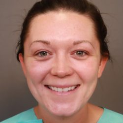 Otoplasty Before & After Patient #3676