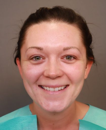 Otoplasty Before & After Patient #3676