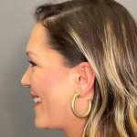 Otoplasty Before & After Patient #3676