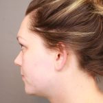 Otoplasty Before & After Patient #3676