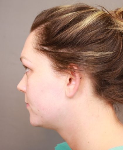 Otoplasty Before & After Patient #3676