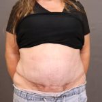 Abdominoplasty Before & After Patient #4138