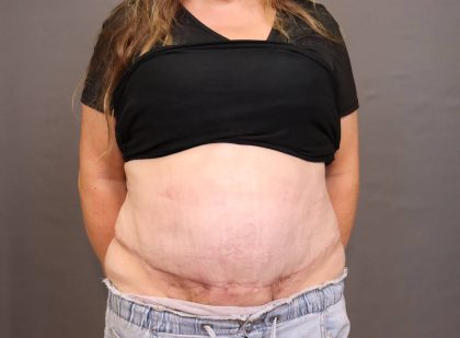 Abdominoplasty Before & After Patient #4138