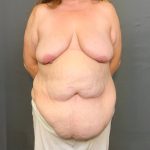 Abdominoplasty Before & After Patient #4138
