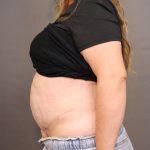 Abdominoplasty Before & After Patient #4138