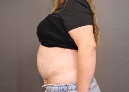 Abdominoplasty Before & After Patient #4138