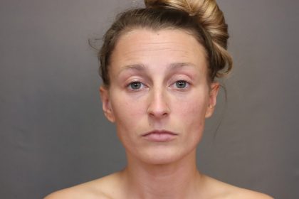 Rhinoplasty Before & After Patient #4443