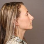 Rhinoplasty Before & After Patient #4443