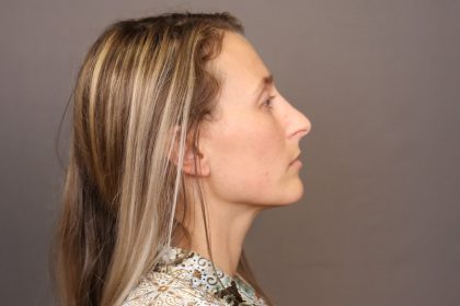 Rhinoplasty Before & After Patient #4443