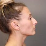 Rhinoplasty Before & After Patient #4443