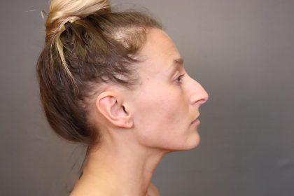 Rhinoplasty Before & After Patient #4443