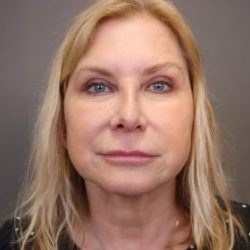 Rhinoplasty Before & After Patient #4442