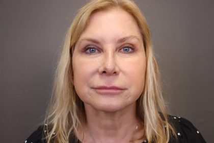 Rhinoplasty Before & After Patient #4442