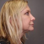 Rhinoplasty Before & After Patient #4442