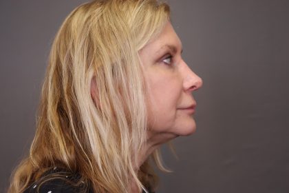 Rhinoplasty Before & After Patient #4442