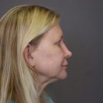 Rhinoplasty Before & After Patient #4442