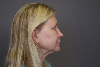 Rhinoplasty Before & After Patient #4442