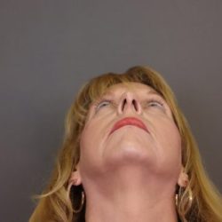 Rhinoplasty Before & After Patient #4441