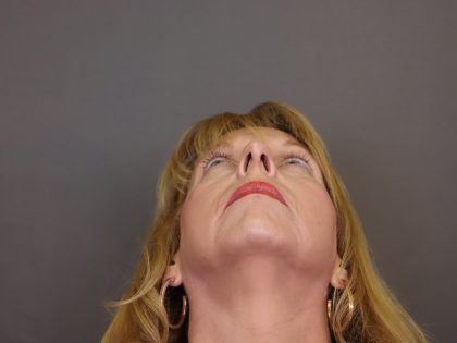 Rhinoplasty Before & After Patient #4441