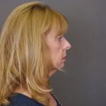 Rhinoplasty Before & After Patient #4441