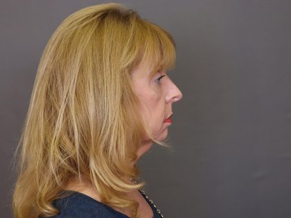 Rhinoplasty Before & After Patient #4441