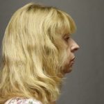 Rhinoplasty Before & After Patient #4441