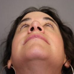 Rhinoplasty Before & After Patient #4440