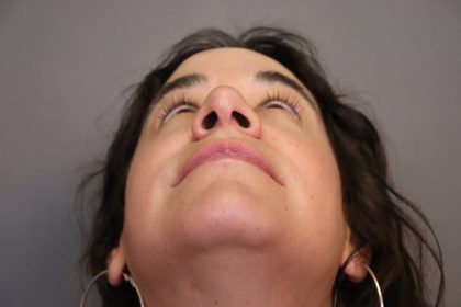 Rhinoplasty Before & After Patient #4440