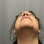 Rhinoplasty Before & After Patient #4440