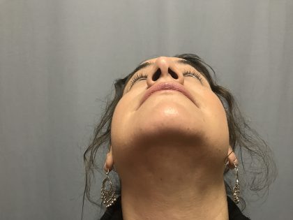 Rhinoplasty Before & After Patient #4440