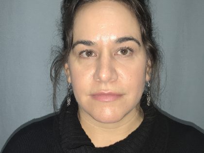 Rhinoplasty Before & After Patient #4440