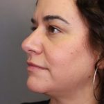 Rhinoplasty Before & After Patient #4440