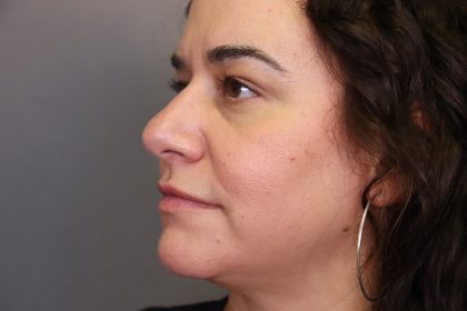Rhinoplasty Before & After Patient #4440
