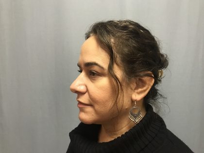 Rhinoplasty Before & After Patient #4440