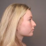 Rhinoplasty Before & After Patient #4439