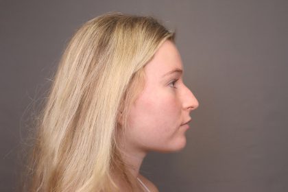 Rhinoplasty Before & After Patient #4439