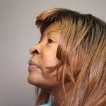 Rhinoplasty Before & After Patient #4438